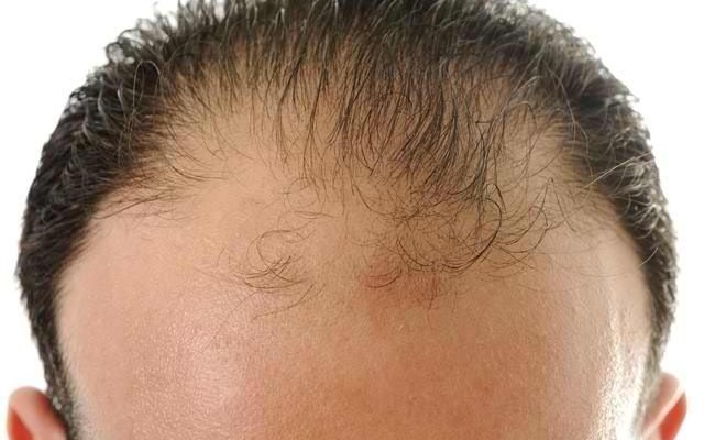 андрогенетична алопеція