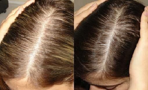 ознаки дифузної алопеції