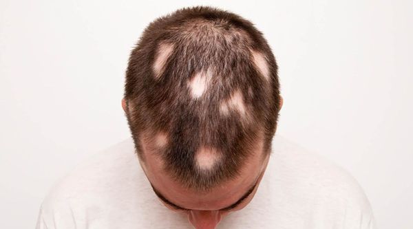 ознаки вогнищевої алопеції